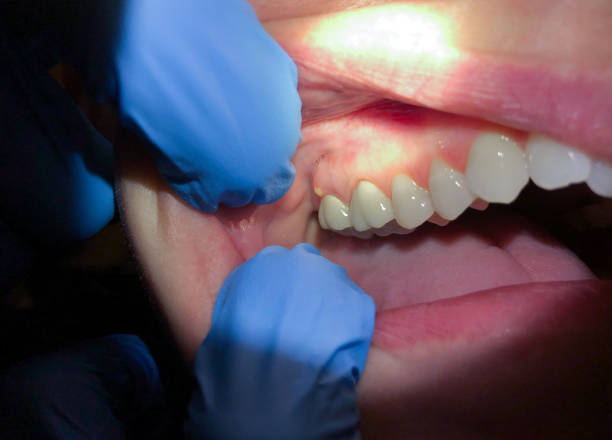 Best Emergency Tooth Extraction in San Ramon, CA
